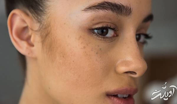 لکه قهوه ای پوستی